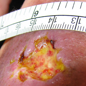 Nonviable, necrotic (dead) tissue is visible in the wound.