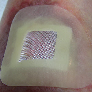 The maggots and the wound are now covered by a hydrocolloid wound dressing.