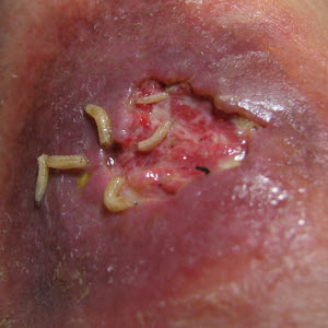 Grown maggots are visible after removal of the dressing.