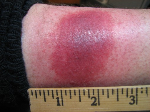 Rash above the ankle, on inside of right leg.